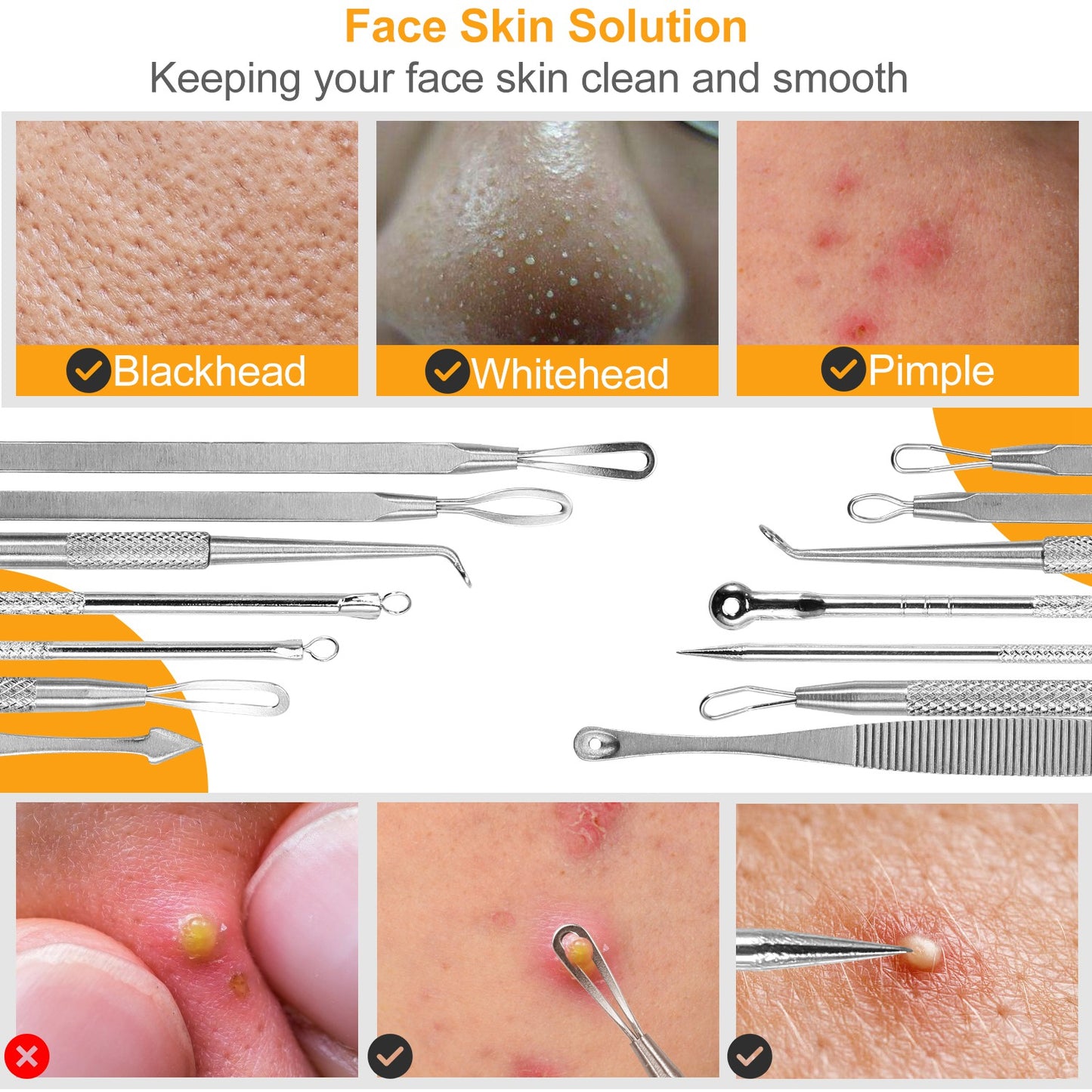 7 Pcs Blackhead Remover Kit Stainless Steel Pimple Comedone Acne Extractor